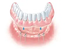 implant-retained-denture