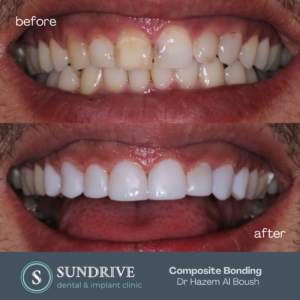 Composite Bonding by Dr. Hazem (1)