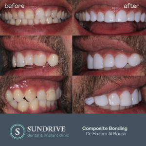 Composite Bonding by Dr. Hazem (2)