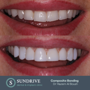 Composite Bonding by Dr. Hazem (3)