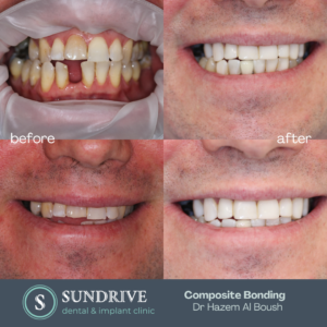 Composite Bonding by Dr. Hazem