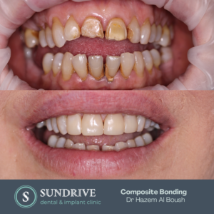 Composite Bonding by Dr. Hazem (4)
