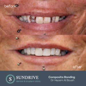 Composite Bonding by Dr. Hazem (5)