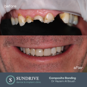 Composite Bonding by Dr. Hazem (6)