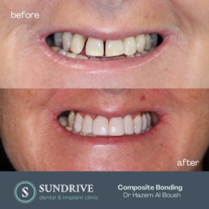 Composite Bonding by Dr. Hazem (7)