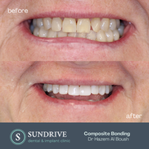 Composite Bonding by Dr. Hazem (9)